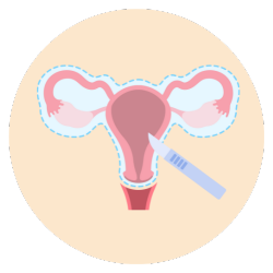 Uterine Fibroids​