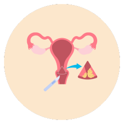 Biopsy of Endometrial Tissue​