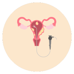 Removal of Polyps and Fibroids​