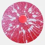 Female Infertility