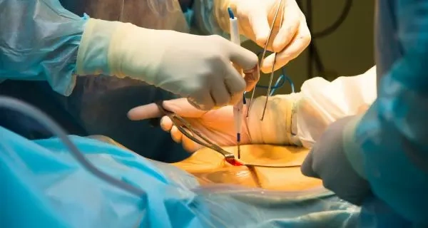 Laparoscopy Procedure