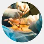 Laparoscopy