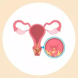 Pelvic Inflammatory Disease (PID)