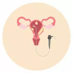 Removal of Polyps and Fibroids​