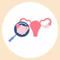 ovulatory disorder