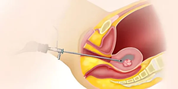 Types of Hysteroscopy Surgery Procedures & Symptoms